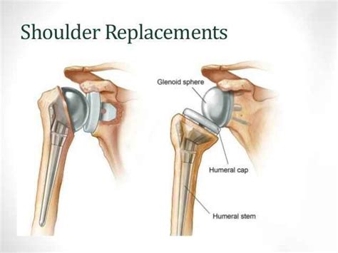 Shoulder Joint Replacement And Rehabilitation - Mobile Physiotherapy Clinic