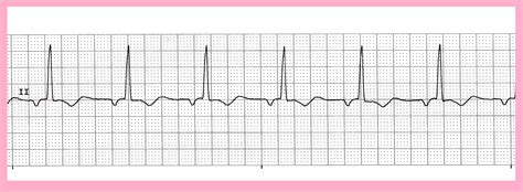 Float Nurse: EKG Rhythm Strip Quiz 195