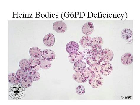 Heinz bodies -G6P Deficiency | Hematology, Medical laboratory science ...