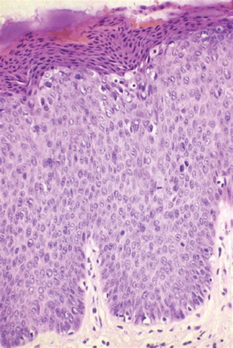 Erythroplasia Of Queyrat Histology