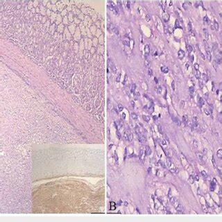 Histopathological image of the gastrointestinal stromal tumor. (A)... | Download Scientific Diagram