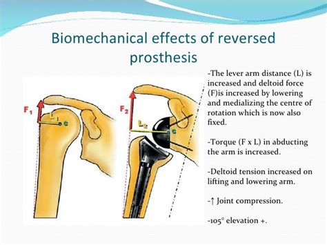 Rehabilitation following a reversed total shoulder arthroplasty nwulg…