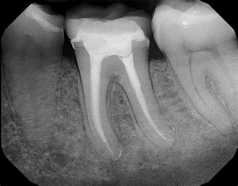 Root Canal Treatment (Endodontic Therapy) - Ideal Dental Care