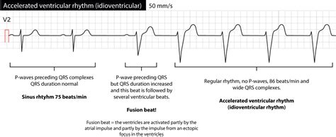 Accelerated Junctional Rhythm