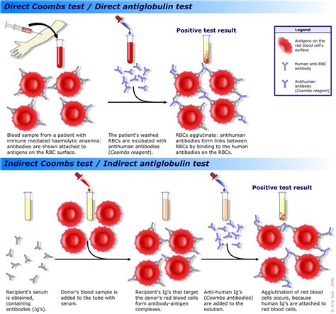 Agglutination - Immunology - Medbullets Step 1