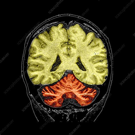 Cerebellar Atrophy, MRI - Stock Image - C004/7509 - Science Photo Library