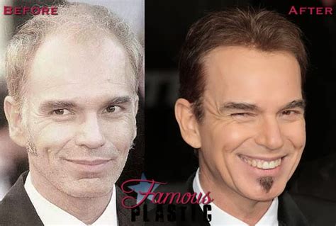 Billy Bob Thornton Plastic Surgery Before and After Facelift and Botox Injections (Star plastic ...