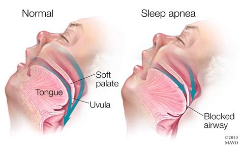 Understanding TMJ Disorders: The Impact of Tongue Position, Airway Function, and Body Posture ...