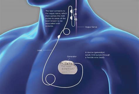 Neuromodulation » Department of Neurology » College of Medicine » University of Florida