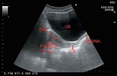 Tilted Uterus Ultrasound Dating – Telegraph