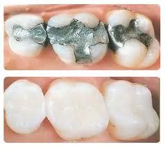 Why you should switch to porcelain fillings