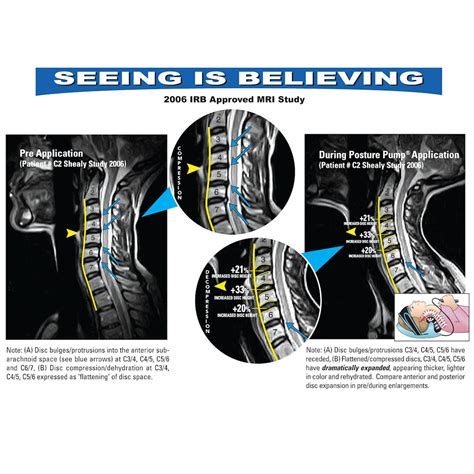 Home Neck Traction Cervical Curve Restoration