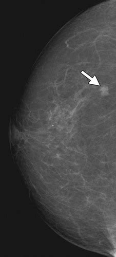 How to Find an Isoechoic Lesion with Breast US | RadioGraphics