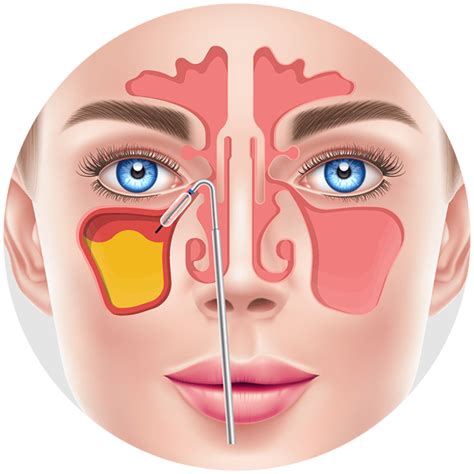 Balloon Sinuplasty - Advanced Sinus Relief Centers