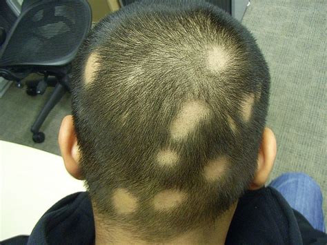 The Hair Loss Centre | Alopecia Treated [Photos]