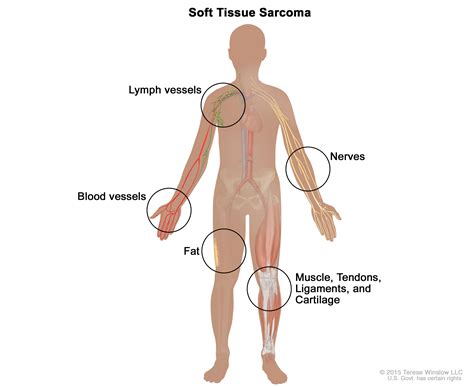 What Is Sarcoma? Types, Survival Rates | OHSU Knight Cancer Institute