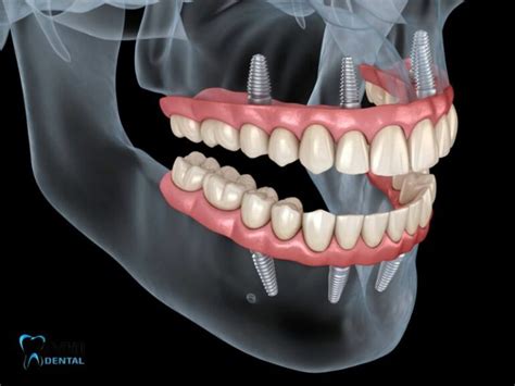 Can you put a Temporary Tooth while waiting for an Implant? - Omni Dental