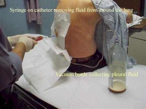 Thoracentesis an procedure thoracentesis informed resting a oct ...