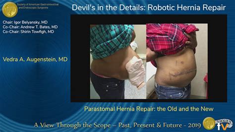 Parastomal Hernia Repair: the Old and the New - YouTube