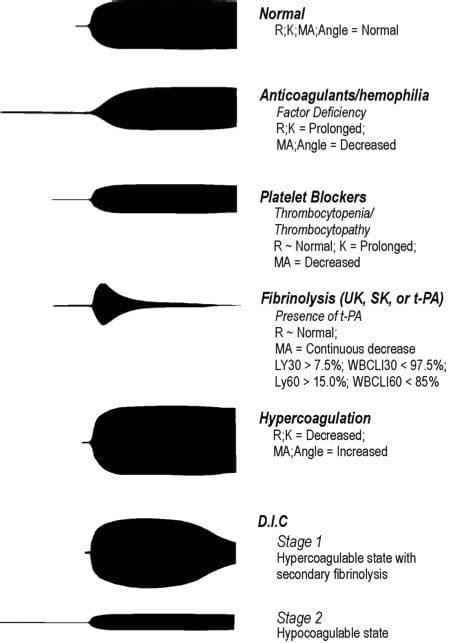 Thromboelastogram (TEG) • LITFL • CCC Investigations