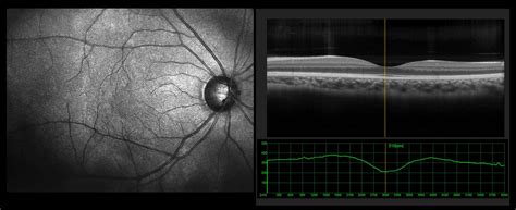 Fluid Behind the Retina: Symptoms, Causes, and Treatment