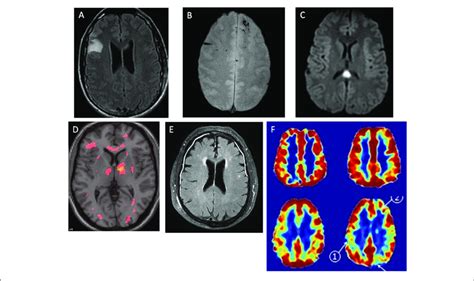 | Magnetic resonance images of patients with post-concussion symptoms ...