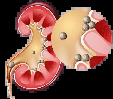 Kidney Stone Treatment in Coimbatore - Kidney Stone Removal Surgery