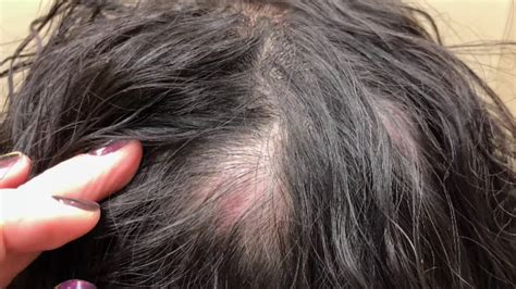 Pimple-Popping Video: This Woman Had Her Scalp Cyst RemovedHelloGiggles