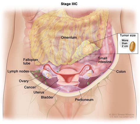 Treatment of Ovarian Epithelial, Fallopian, & Peritoneal Cancers - NCI