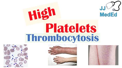 What Causes High Platelets (Thrombocytosis) | Approach to Causes, Symptoms, Treatment - YouTube