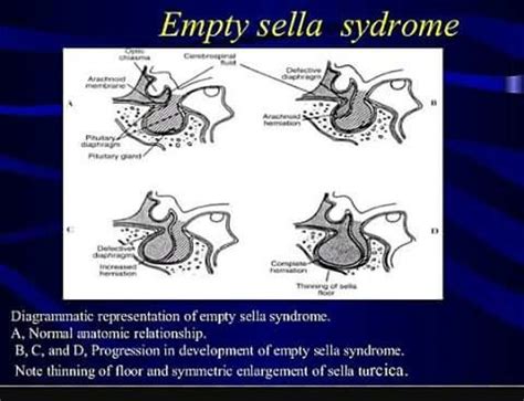 Empty sella symdrome | Empty Sella Syndrome | Pinterest