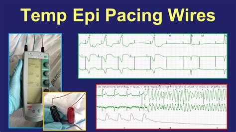 Surgical epicardial pacing wires - uses and management - YouTube