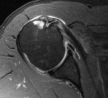 Pathology of the Long Head of the Biceps Tendon | Radsource