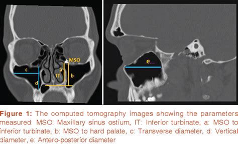 Figure 1 from Anatomy of maxillary sinus and its ostium: A radiological study using computed ...