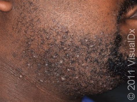 Razor Bumps (Pseudofolliculitis Barbae) Condition, Treatments and Pictures for Adults - Skinsight