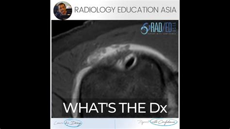 Subdeltoid Bursitis Mri