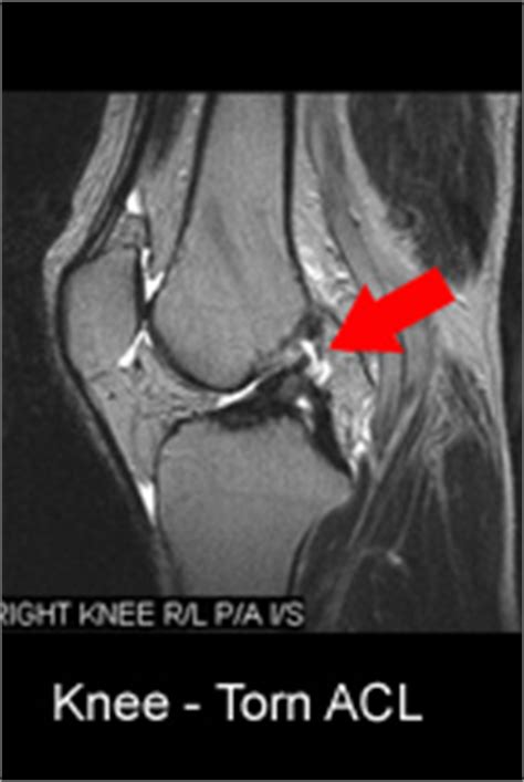 MRI Images - torn ACL and normal ACL