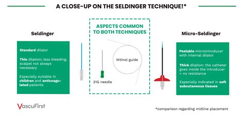 The Seldinger technique: when to use the classical or modified method - VascuFirst