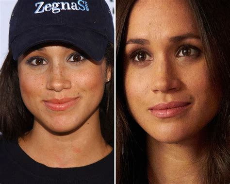 Did Meghan Markle Get a Nose Job? Plastic Surgeons Weigh In!