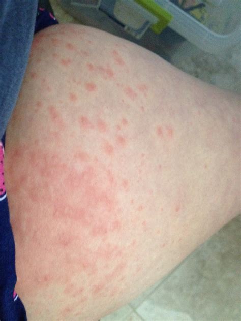 Pruritic Urticarial Papules and Plaques of Pregnancy (PUPPP Rash)