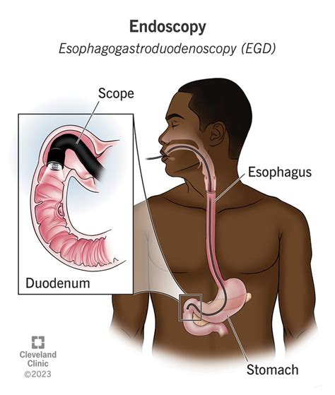 Endoscopy: Procedure, Types, What To Expect