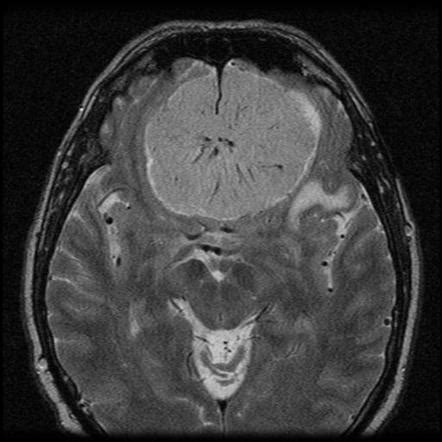 Olfactory groove meningioma - huge | Radiology Case | Radiopaedia.org