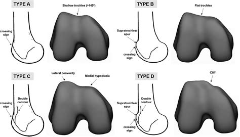 Correlation of Femoral Trochlear Dysplasia With Anterior Cruciate Ligament Injury in Skeletally ...