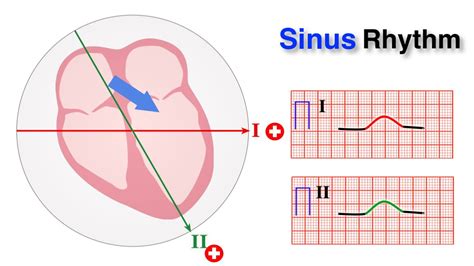 ECG basics 7/10 - Determining Normal Sinus Rhythm - YouTube