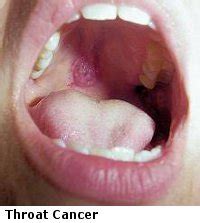 What Does Throat Cancer Look Like Images : Q A What You Should Know ...