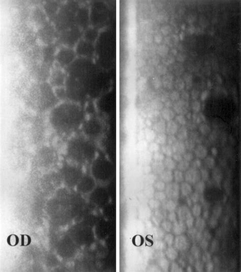 Confocal microscopy in cornea guttata and Fuchs’ endothelial dystrophy ...