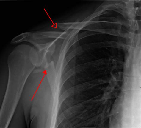 Scapular fracture - WikEM