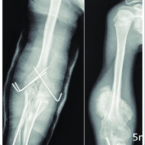 c: Heterotopic calcification in tuberculosis; popliteal abscess ...