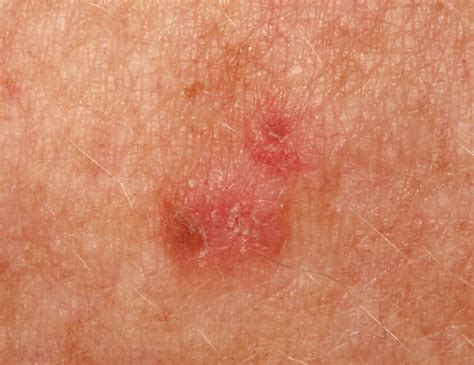 Actinic Keratosis Mimicking Seborrheic Dermatitis » Scary Symptoms