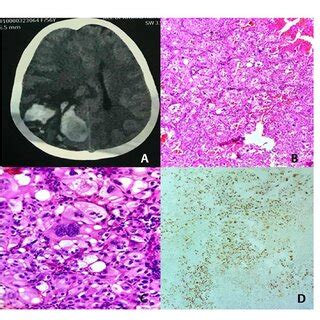 (A) CT scan showing a heterogeneous hypodense lesion in right parietal... | Download Scientific ...